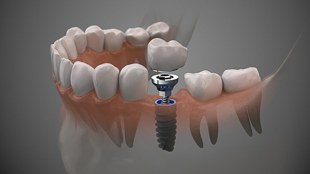 Implantes Dentários: O Sorriso que Você Sempre Sonhou, Agora é Possível!